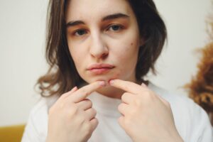 Acne Types: Symptoms, Causes, Treatment, Home Remedies