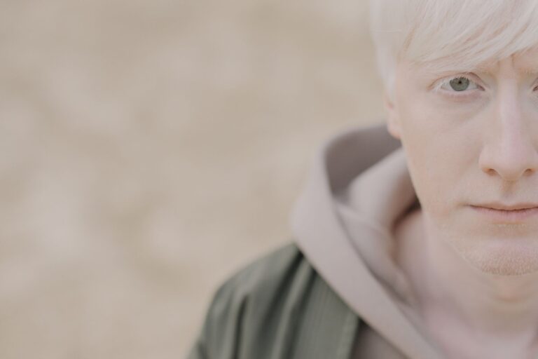 Albinism: Causes, Symptoms, Treatment