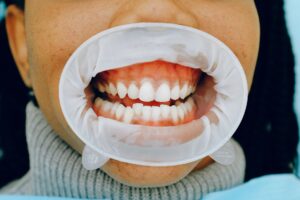 Black Gums: Causes, Symptoms, Treatment, Prevention
