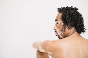 Patchy Skin Color Indicates about Circulation: 5 Patterns