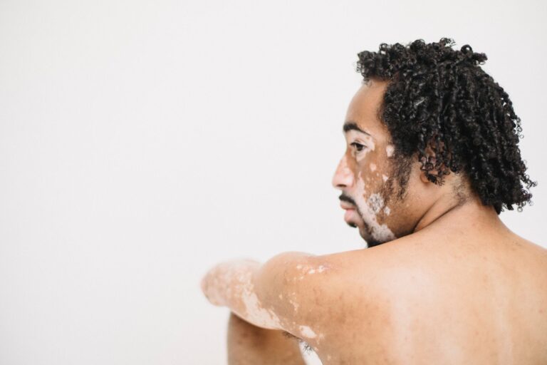 Patchy Skin Color Indicates about Circulation: 5 Patterns