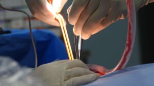 Septicemia: Causes, Signs, Treatment, Complications