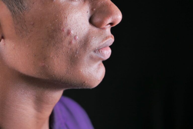Vitamin B12 Acne: Causes, Timeline, and What to Do